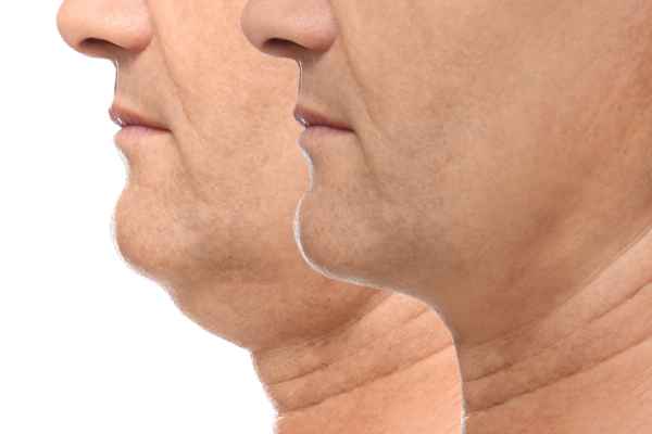 HIFU - Breakthrough in Anti - ageing 2 hifu results Busby