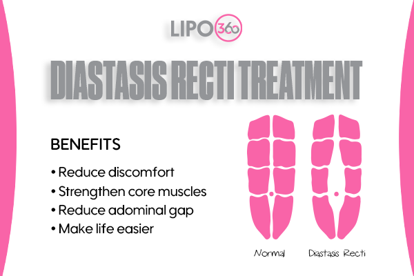 Revolutionising Muscle Repair: The Power of LIPO360 Body Sculpt Post-Injury 5 diastasis recti treatment Busby