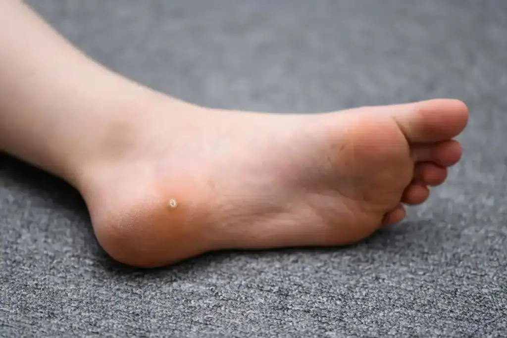 Cryotherapy For Warts And Also Verrucas 2 Image of verruca on the bottom of the foot that able to be treated with Cryotherapy Busby