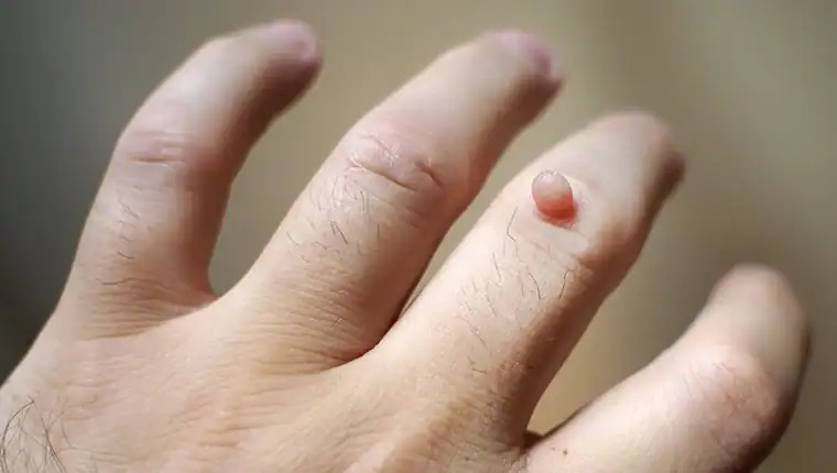 Image of blemish that Cryotherapy Busby can remove with Lipo 360.