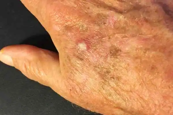 Image of Actinic keratoses Busby on a person hand
