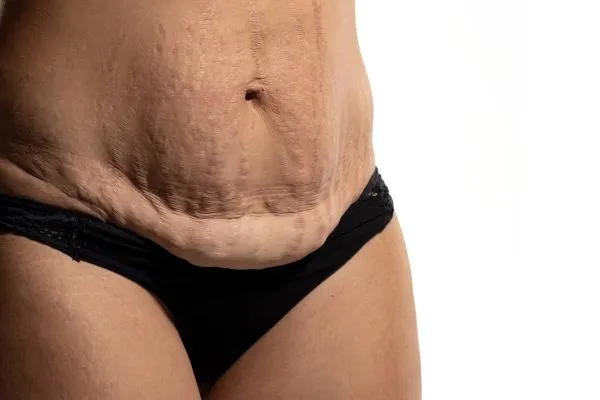 The science behind skin tightening Busby picture of a woman's sagging skin on the stomach
